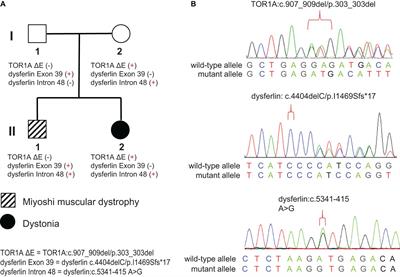 Integrated Genome and Transcriptome Sequencing to Solve a Neuromuscular Puzzle: Miyoshi Muscular Dystrophy and Early Onset Primary Dystonia in Siblings of the Same Family